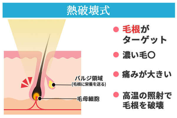 熱破壊式脱毛の特徴