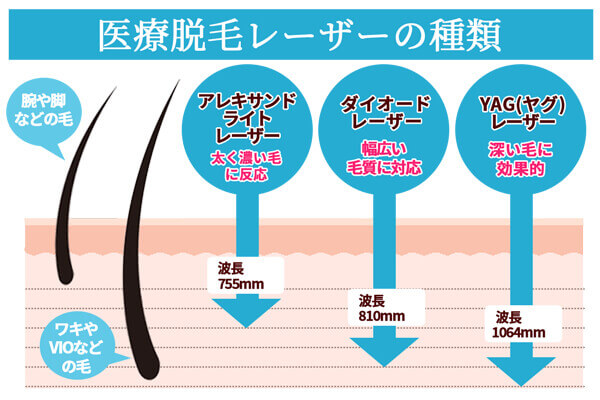 医療脱毛レーザーの種類