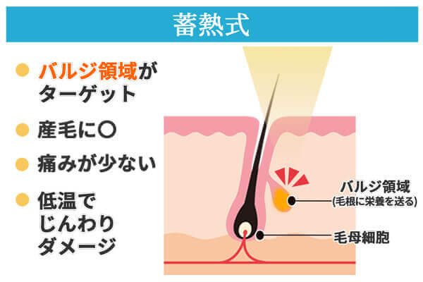 蓄熱式脱毛の特徴