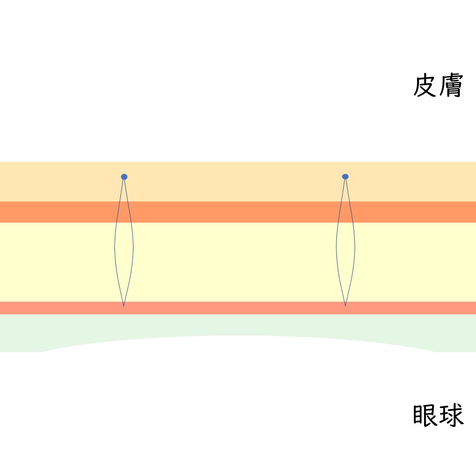 二重整形 埋没法 切開法 福岡天神で美容外科 美容皮膚科はトータルスキンクリニック